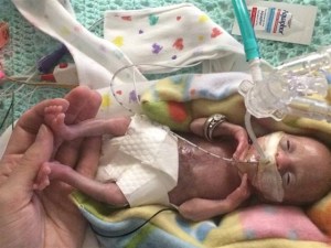 Source: https://www.today.com/health/born-21-weeks-she-may-be-most-premature-surviving-baby-t118610